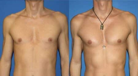 patient-12875-chest-augmentation-before-after