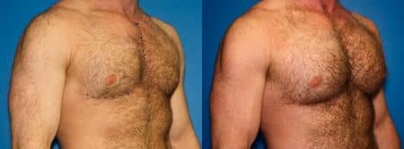 patient-12886-chest-augmentation-before-after-1