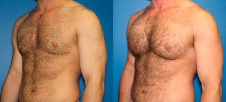 patient-12886-chest-augmentation-before-after-2