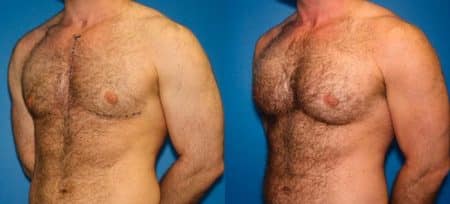 patient-12886-chest-augmentation-before-after-3