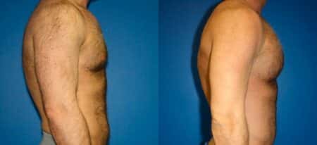 patient-12886-chest-augmentation-before-after-4