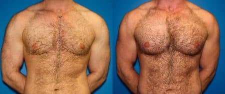 patient-12886-chest-augmentation-before-after