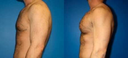 patient-12886-chest-augmentation-before-after-5