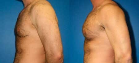 patient-12886-chest-augmentation-before-after-6