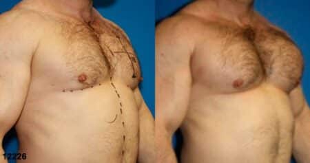 patient-12901-chest-augmentation-before-after-1