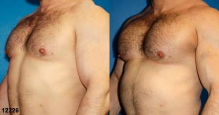 patient-12901-chest-augmentation-before-after-2