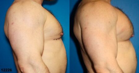 patient-12901-chest-augmentation-before-after-3