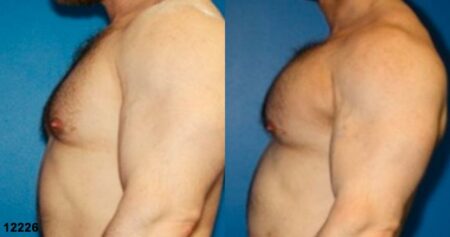 patient-12901-chest-augmentation-before-after-4