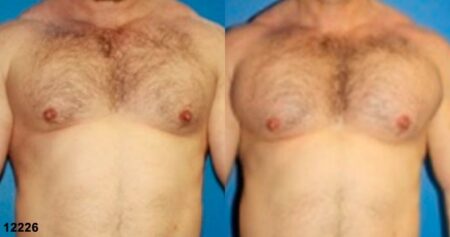 patient-12901-chest-augmentation-before-after