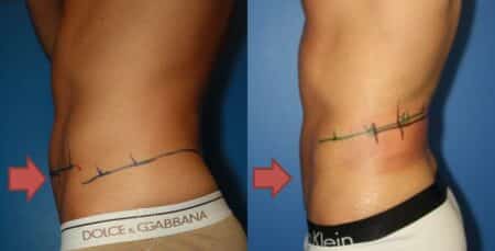 patient-12915-coolsculpting-before-after