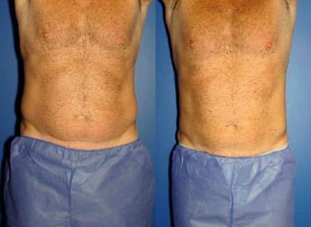 patient-12918-coolsculpting-before-after