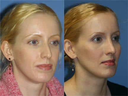 Cheek implants to augment the midface and rhinoplasty to correct nasal bridge of a female patient by Dr. Miller. Surgery creates straight nasal bridge while augmenting the midface.