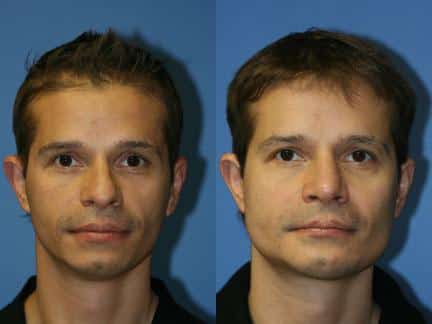 Cheek, jaw, and chin implants to augment the mid and lower face of a male patient by Dr. Miller. After surgery, patient's facial contour is stronger and more masculine.