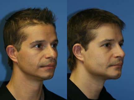 patient-12961-cheek-implants-before-after-5