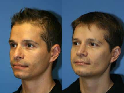 patient-12961-cheek-implants-before-after-6