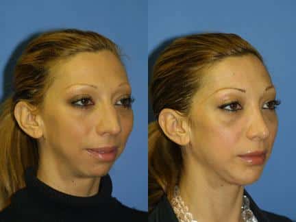 Jaw implants to add fullness to the jawline of a female patient by Dr. Miller. After surgery, jawline is more defined and proportionate to the rest of the facial contour.