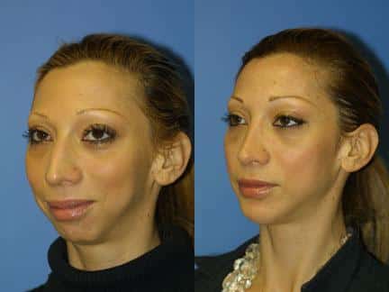 patient-12970-jaw-implants-before-after-2