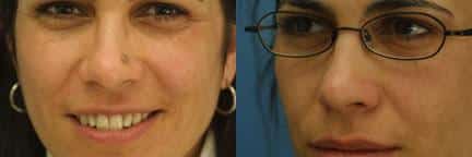 Lesion removal on the nose by Dr. Miller. After treatment, brown spot on side of nose is completely gone.