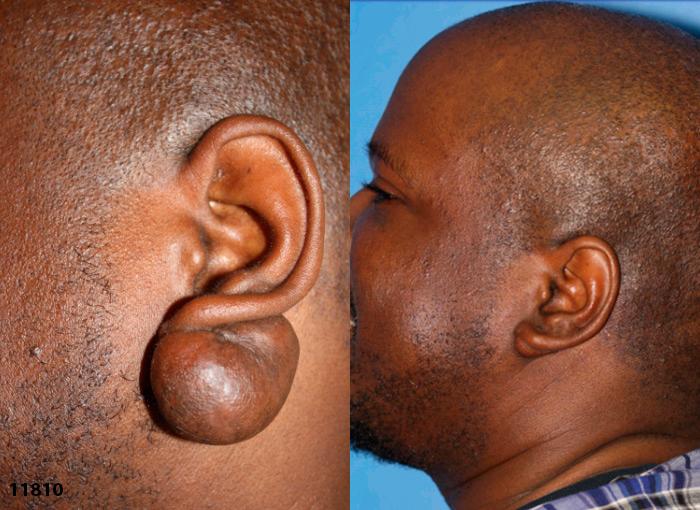 Lesion removal to eliminate a growth under the ear. After treatment, growth is completely gone and ear lobe has resumed its normal shape an position.