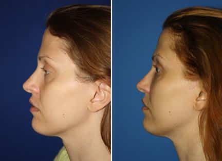 patient-13001-fat-injections-before-after-1