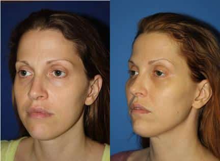 Fat injections to add fullness and Ultherapy to firm the skin of a female patient by Dr. Miller. Treatment produces a more youthful facial contour.