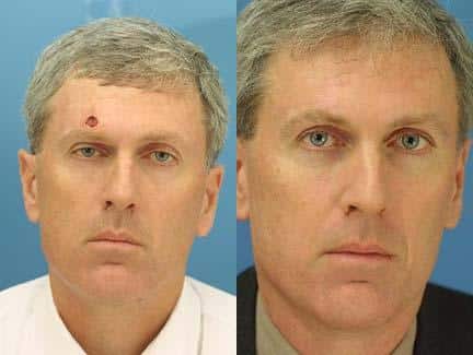 Reconstruction to remove scar left behind after Moh's surgery on a male patient by Dr. Miller. After surgery, scar is no longer visible.