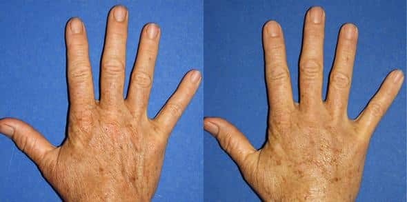Hand rejuvenation using dermal fillers to reduce prominent veins and wrinkles in a female patient. After treatment, skin is smoother and more youthful.