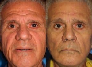 patient 1305 facelift before after