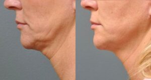 Image showing an older woman having her loose skin lifted and tightened after having a new non-invasive procedure called Ultherapy, New York, NY