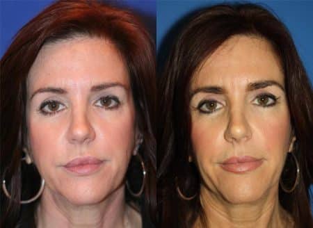 Facial Wrinkle Treatments