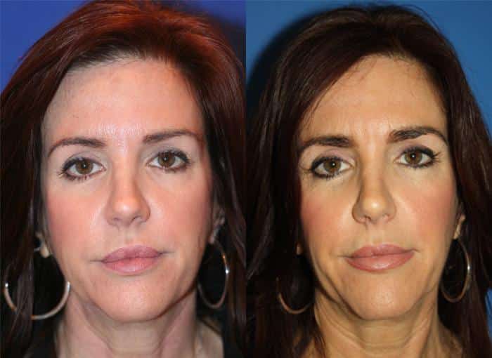 Botox injections to treat glabellar and forehead lines on a female patient by Dr. Miller. After treatment, forehead is visibly smoother and more youthful.