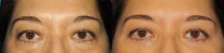 Blepharoplasty Before After