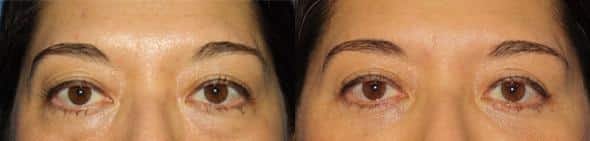 Upper blepharoplasty to reduce hooding and creases on the upper eyelid of a female patient by Dr. Miller. Surgery creates a smoother upper lid and a refreshed appearance.
