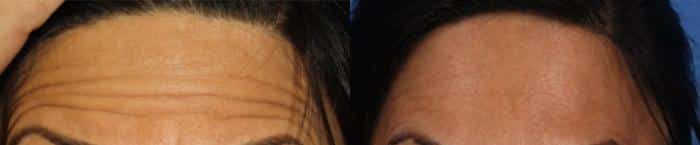 Botox to treat horizontal forehead wrinkles on a female patient by Dr. Miller. After treatment, forehead is smoother and line-free.