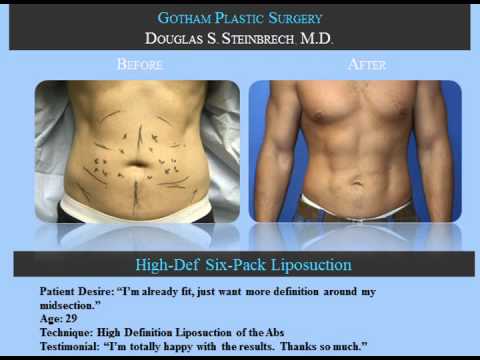 Male liposuction before and after photos of NYC patients