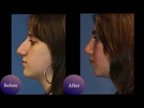 Nose job before & after photos of NYC patients