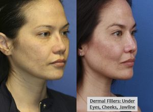 Two images of a female patient, before and after she had dermal fillers, her face looking more refreshed and youthful after dermal fillers, New York City, NY