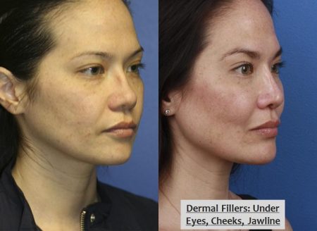 patient-12413-wrinkle-treatments-before-after