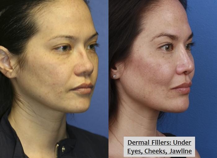 dermal fillers for wrinkles results