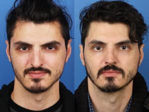 Man with asymmetrical nose is seen in left picture, and has a straight nose after rhinoplasty in the second picture.