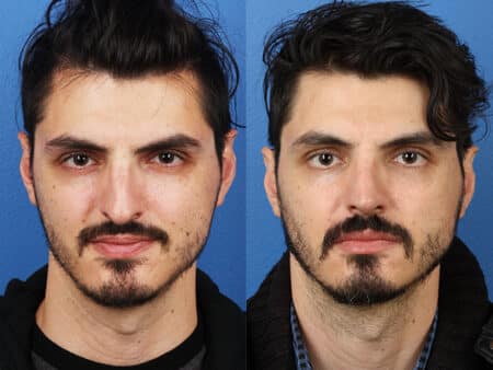 Before and After Rhinoplasty by Dr. Miller