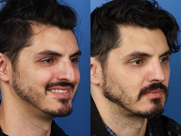 Rhinoplasty to remove a bump, refine the tip and improve the shape of the nose of a male patient. Drooping tip is rotated and nose shape and size is brought into proportion with other facial features.