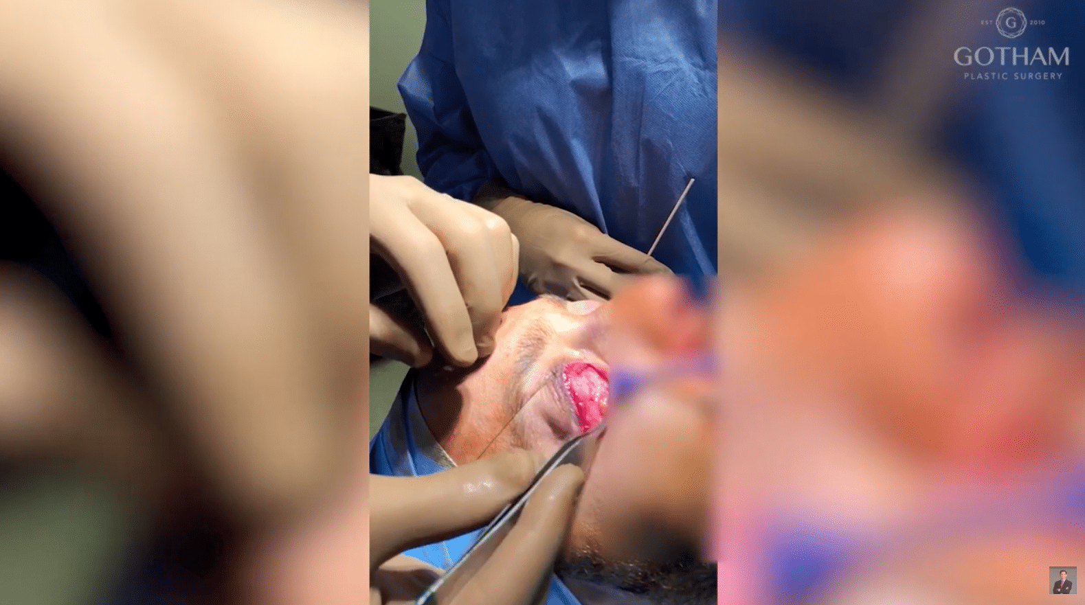 Customized Corrected Face Implant Surgery