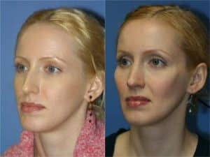 anti aging cosmetic surgery treatments in new york, ny