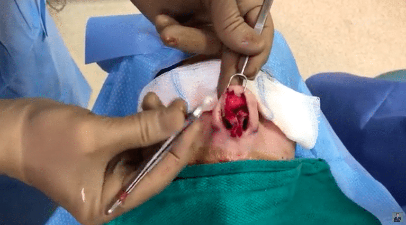 Nose Narrowing Limitations with Dr. Miller