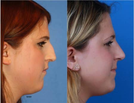 Rhinoplasty with Dr. Miller
