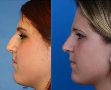 Rhinoplasty with Dr. Miller