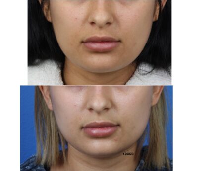 Buccal Fat Removal with Dr. Miller