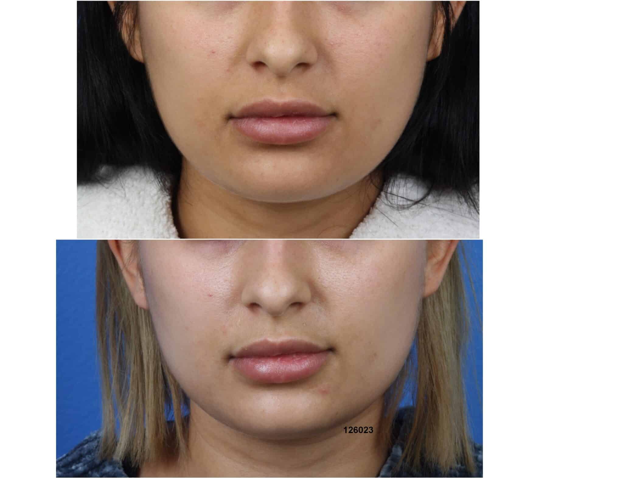 Buccal fat removal to slim the lower face of a female patient. Once the fat pads inside the cheeks are removed, the face is noticeably slimmer with a more pleasing shape and contour.