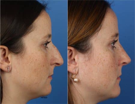 Rhinoplasty with Dr. Miller